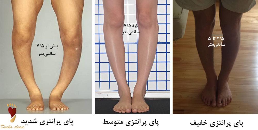 چگونه تشخیص دهیم پای پرانتزی داریم؟