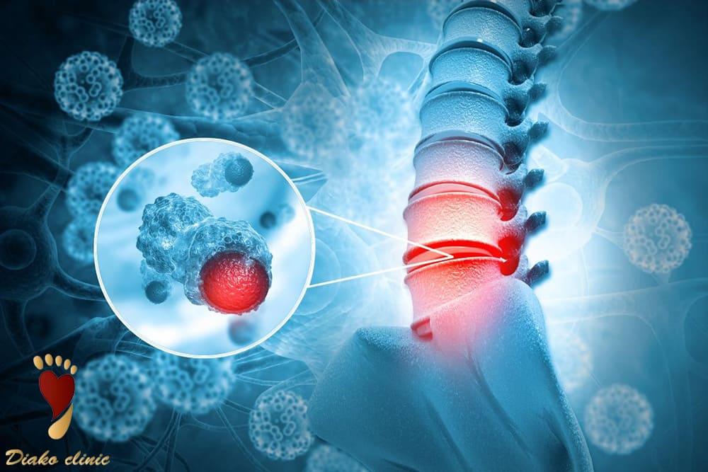 گودی کف پا به دلیل تومور ستون فقرات
