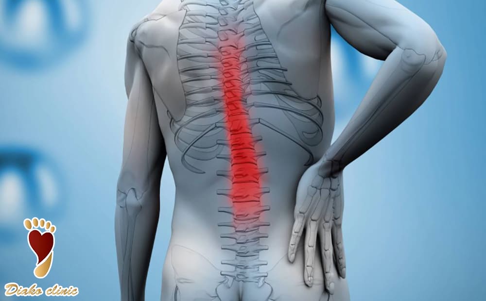 آسیب نخاعی یکی از دلایل ایجاد گودی کف پا