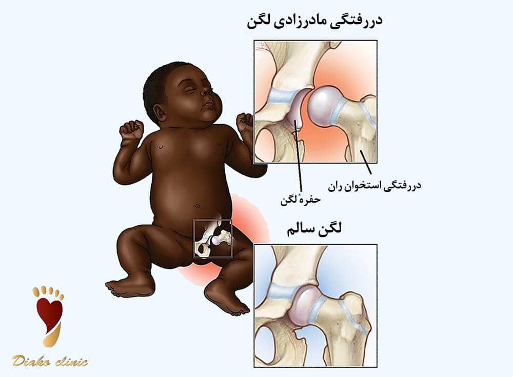 دررفتگی مادرزادی لگن در اثر رشد نکردن کامل مفصل لگن نوزاد