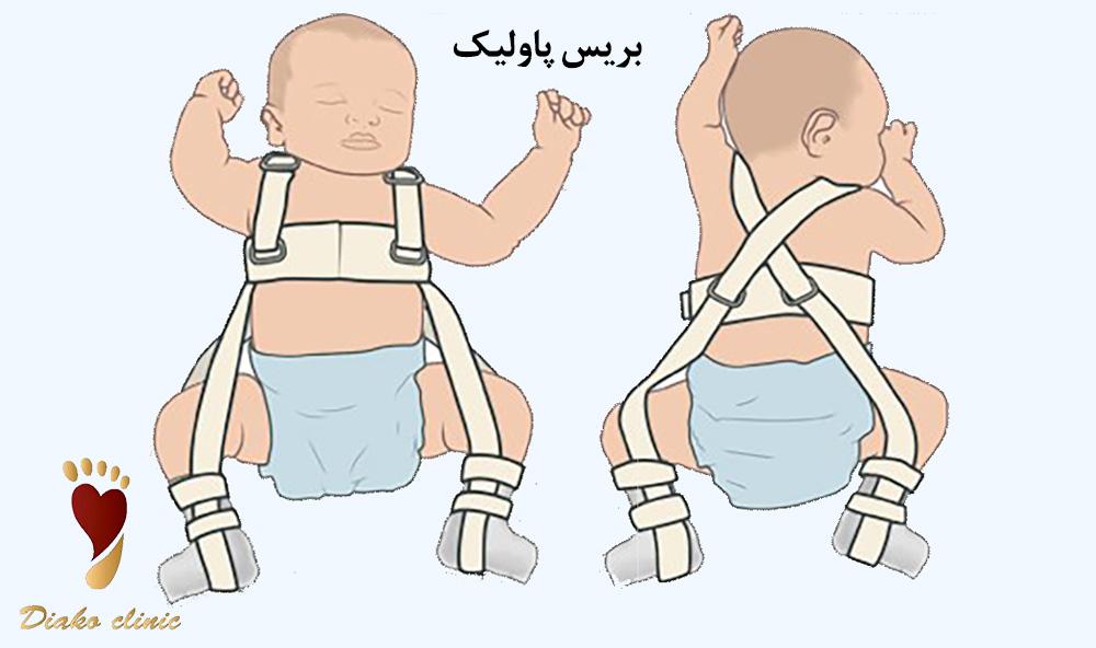 بریس پاولیک یکی از روشهای درمانی دررفتگی مادرزادی لگن