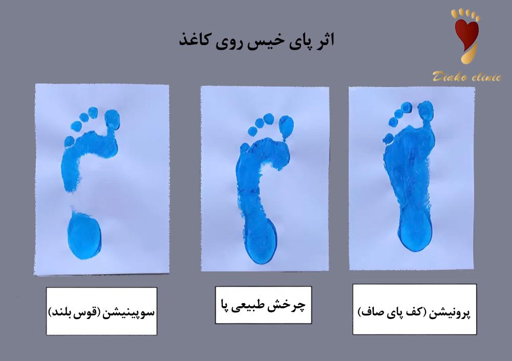 بررسی اثر پای خیس روی کاغذ و تشخیص ناهنجاری پا