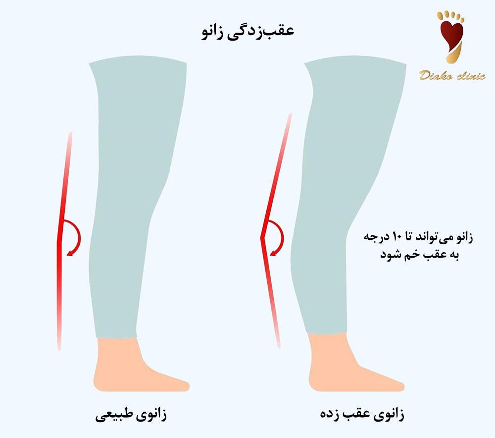 علائم عقبزدگی زانو