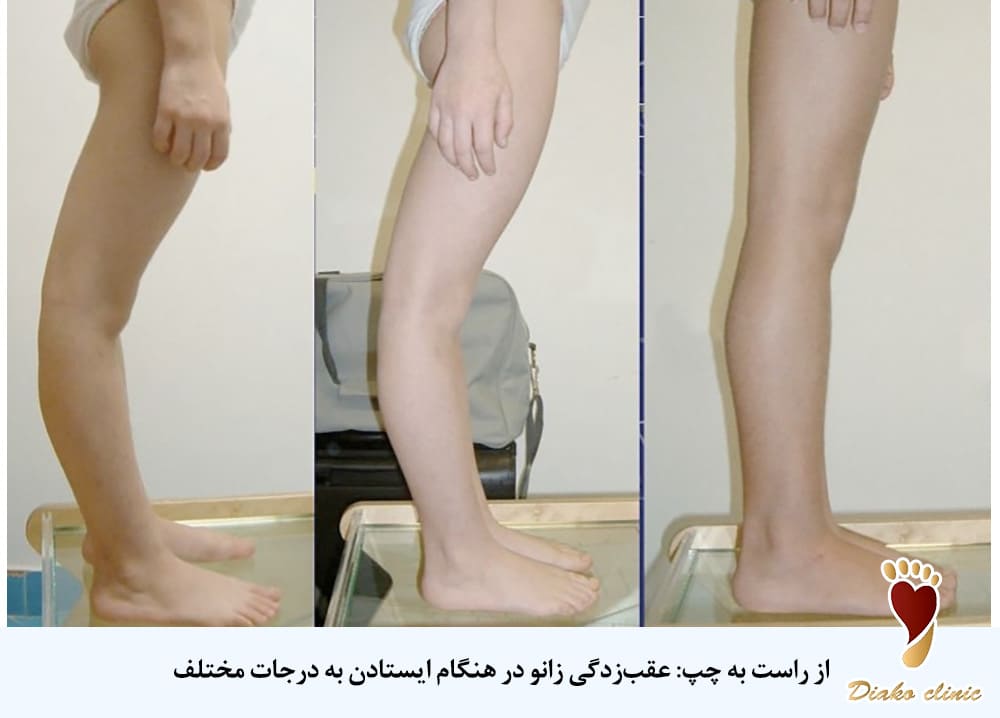شکل پا در حالت ایستاده