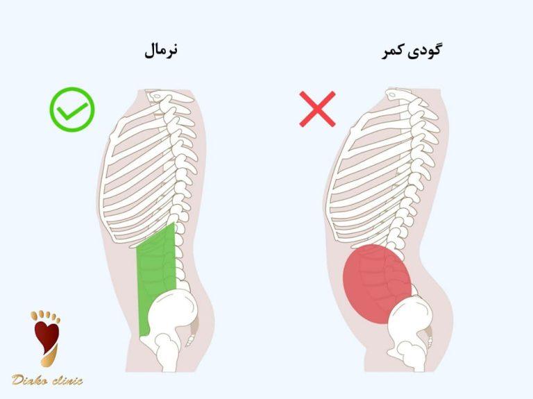 گودی یا قوس کمر در کودکان و درمان آن