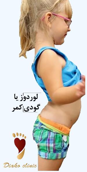 لوردوز یا گودی کمر