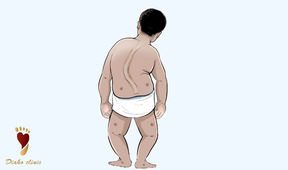 ضعف عضلات کودک به دلیل اختلالات ژنتیکی 
