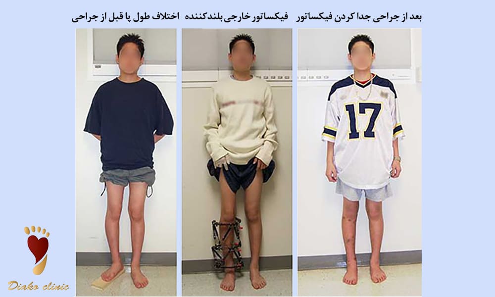 بلندکردن اندام خارجی