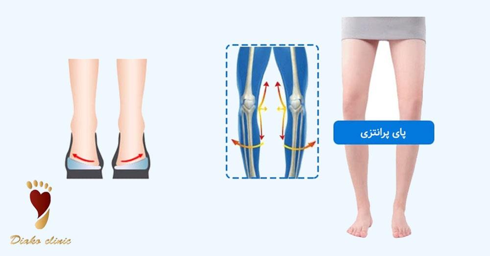 کفشهای مخصوص پای پرانتزی