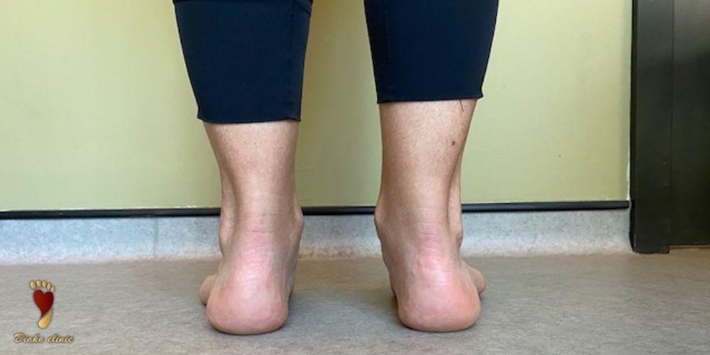 کف پای صاف (Flat Feet)