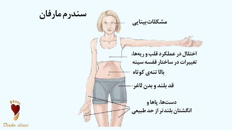 سندروم مارفان چیست؟