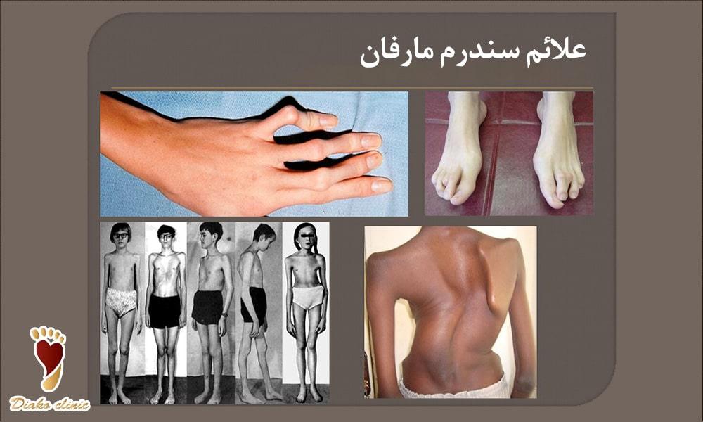 علائم سندرم مارفان