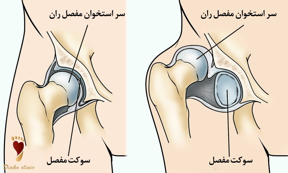 دررفتگی مادرزادی لگن