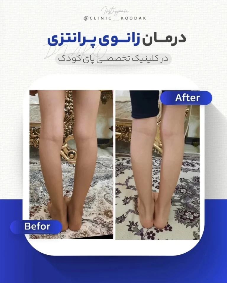 درمان زانو پرانتزی