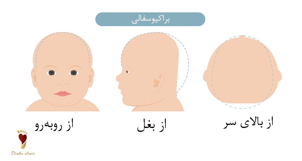براکیوسفالی