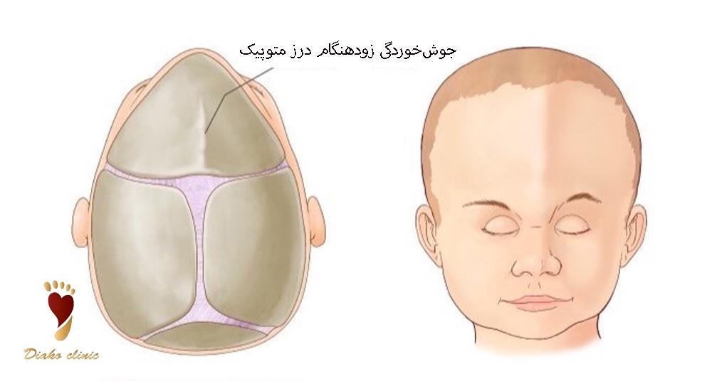 کرانیوسینوستوز