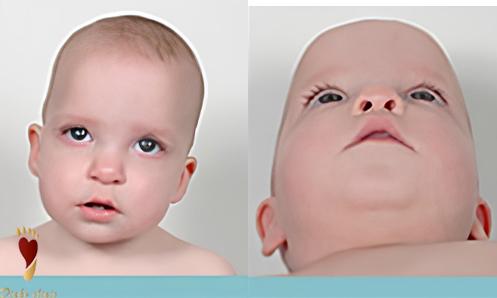 علائم تشخیصی اسکافوسفالی