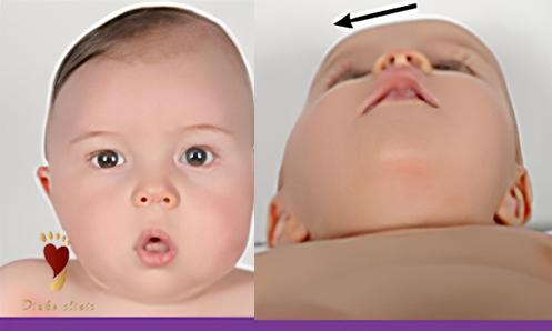 علائم تشخیصی پلاژیوسفالی