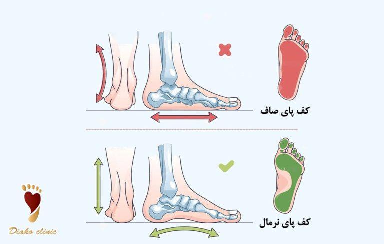 تست تشخیص صافی کف پا