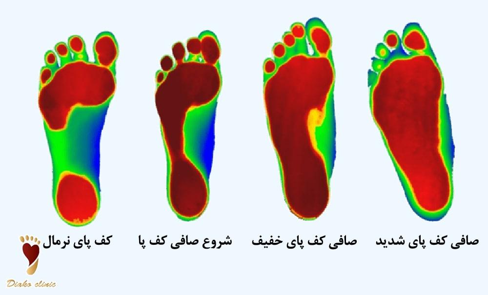 تفسیر اسکن فشاری و دوبعدی پا