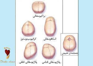 بدشکلی سر نوزاد