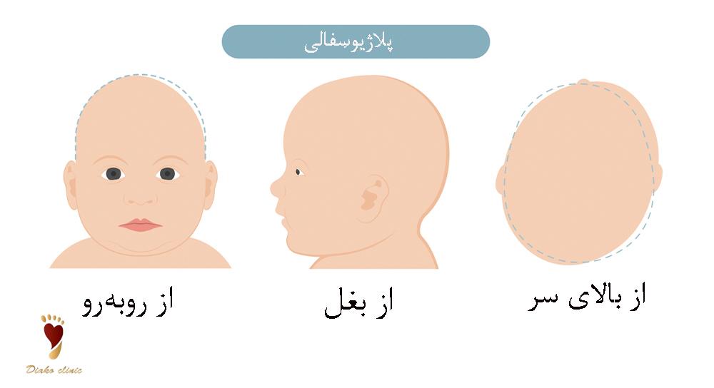 پلاژیوسفالی