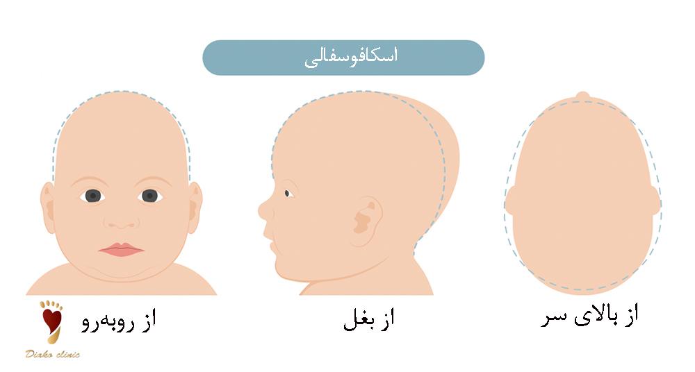  اسکافوسفالی
