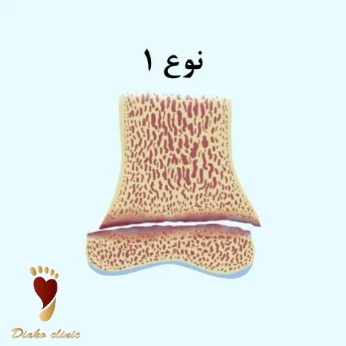 شکستگی فقط در صفحه رشد