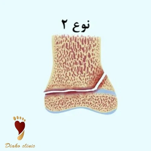 شایع ترین نوع شکستگی