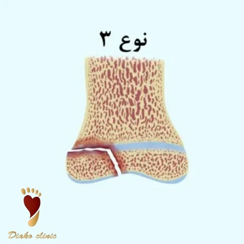 شکستگی در صفحه رشد و استخوان